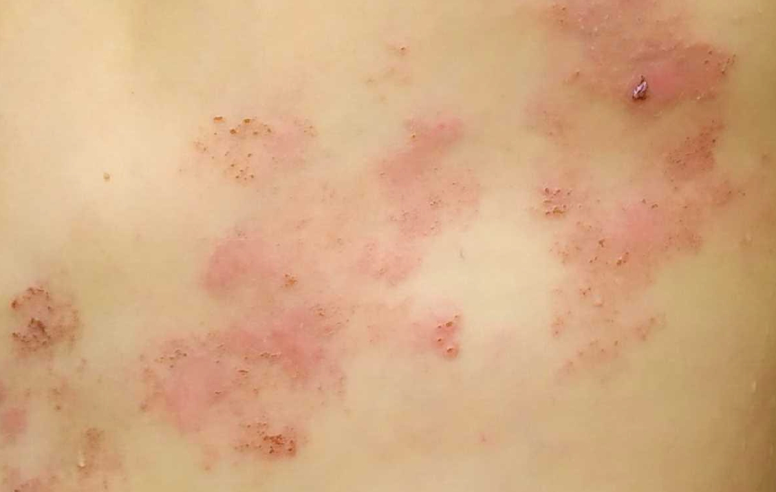 照時間來食藥，多歇睏、減少壓力，提高免疫力，差毋多兩三隻禮拜皮蛇就會好哩。作者提供