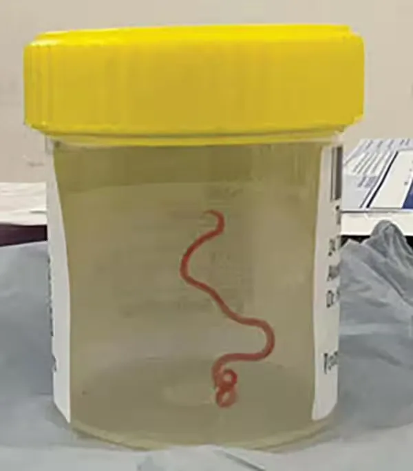 老婦腦中取出的活體蛇蛔蟲。翻攝自美國CDC官方網站