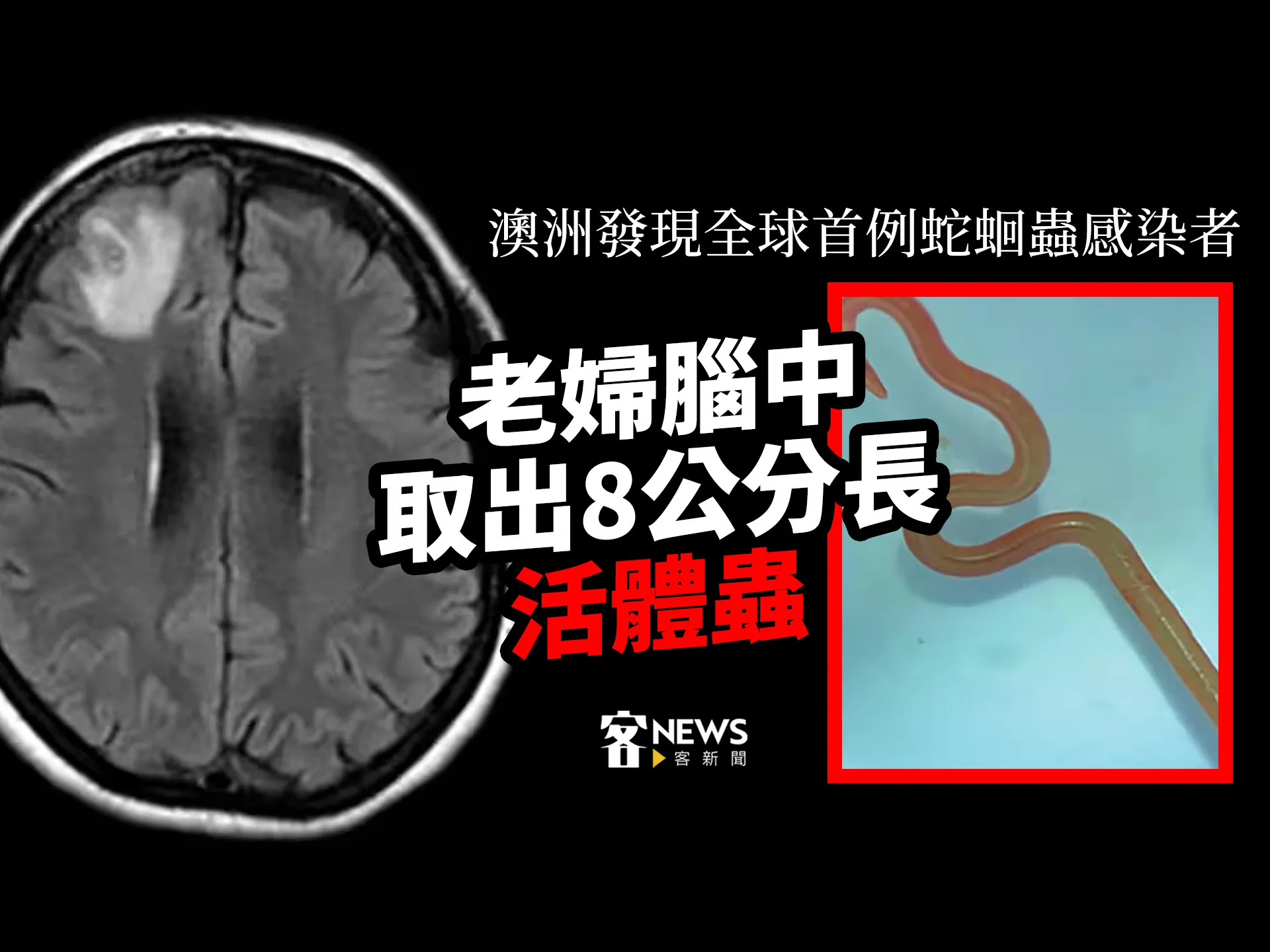 澳洲發現全球首例蛇蛔蟲感染者　老婦腦中取出8公分長活體蟲