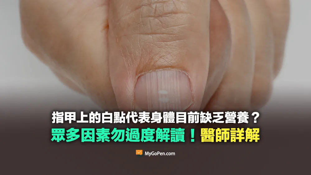 【誤導】指甲上的白點代表身體缺乏鋅等礦物質？勿過度解讀！醫師詳解