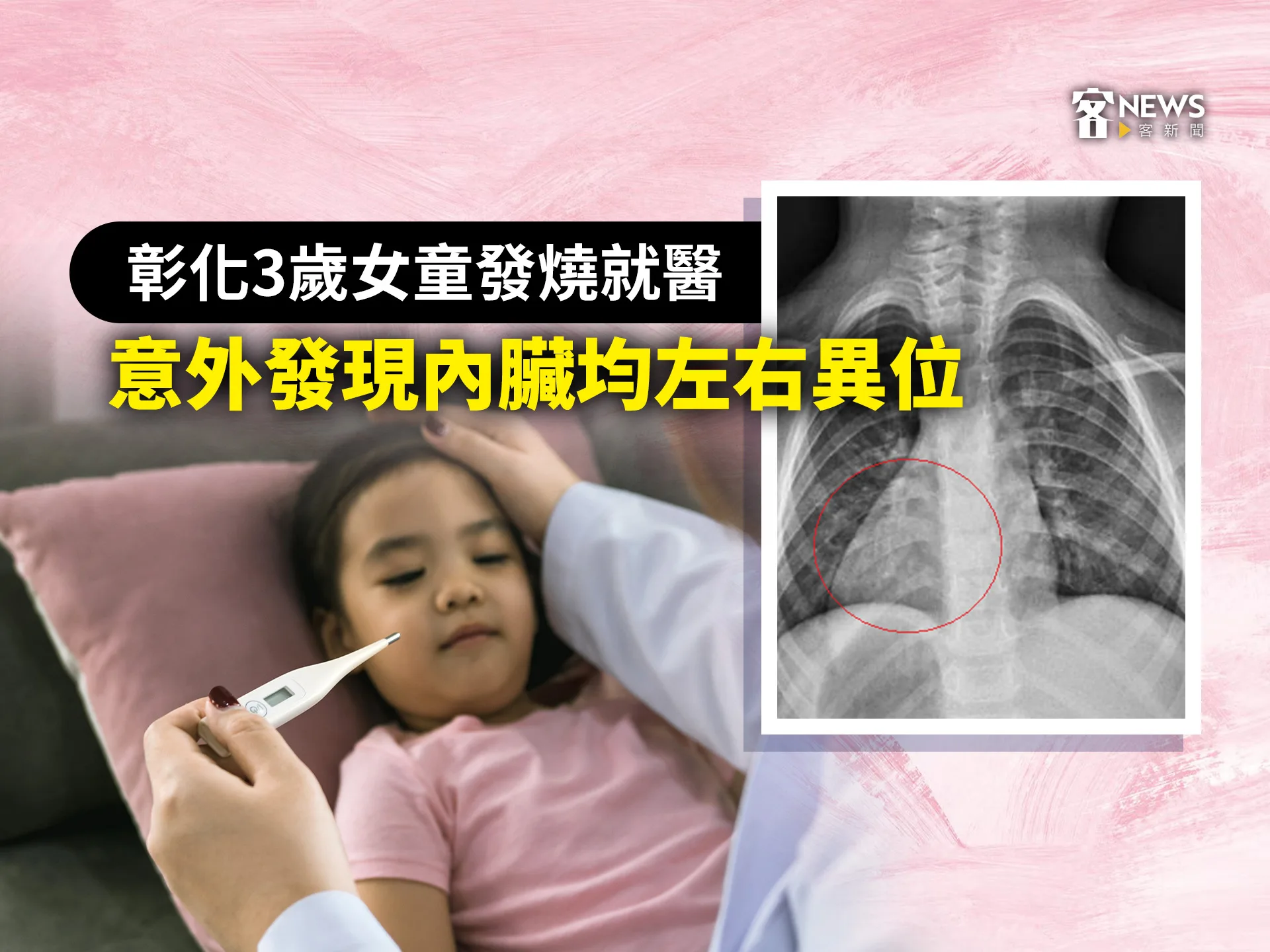 彰化3歲女童發燒就醫　意外發現內臟均左右異位