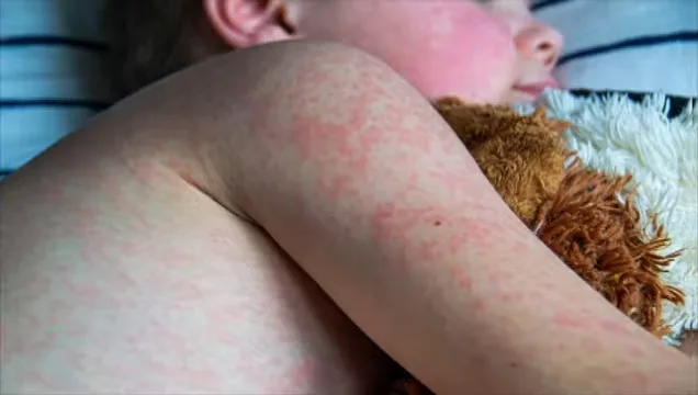 美麻疹疫情升溫　南卡州累計確診逾600例